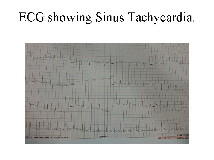 ECG showing Sinus Tachycardia. 