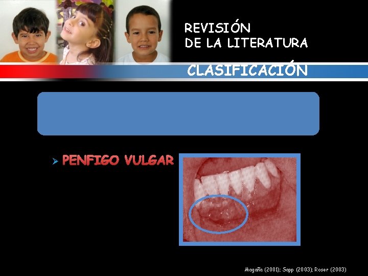 REVISIÓN DE LA LITERATURA CLASIFICACIÓN 1. ALTERACIONES GINGIVALES RELACIONADAS CON ENFERMEDADES MUCOCUTANEAS Y/O INMUNOLOGICAS