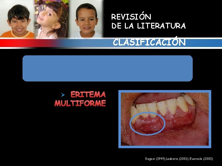 REVISIÓN DE LA LITERATURA CLASIFICACIÓN 1. ALTERACIONES GINGIVALES RELACIONADAS CON ENFERMEDADES MUCOCUTANEAS Y/O INMUNOLOGICAS