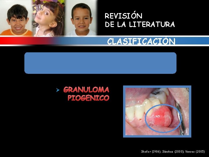 REVISIÓN DE LA LITERATURA CLASIFICACIÓN 2. ALTERACIONES GINGIVALES RELACIONADAS CON NIVELES HORMONALES Ø GRANULOMA