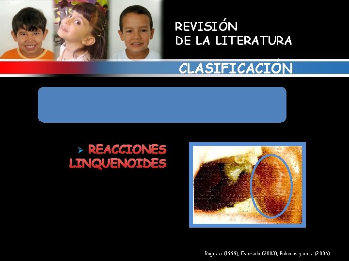 REVISIÓN DE LA LITERATURA CLASIFICACIÓN 3. ALTERACIONES GINGIVALES RELACIONADAS CON FARMACOS REACCIONES LINQUENOIDES Ø
