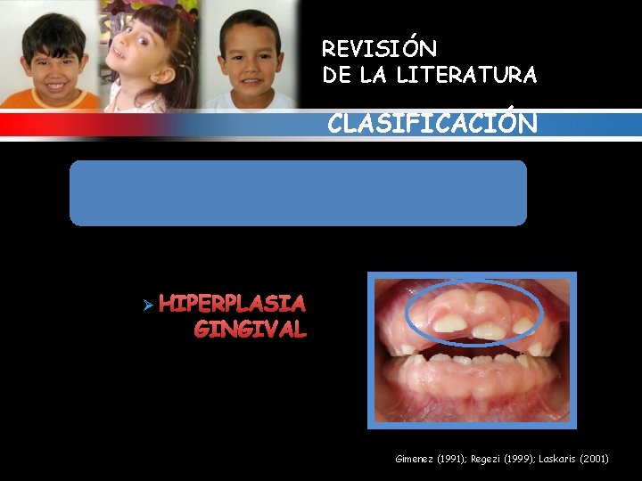 REVISIÓN DE LA LITERATURA CLASIFICACIÓN 3. ALTERACIONES GINGIVALES RELACIONADAS CON FARMACOS Ø HIPERPLASIA GINGIVAL