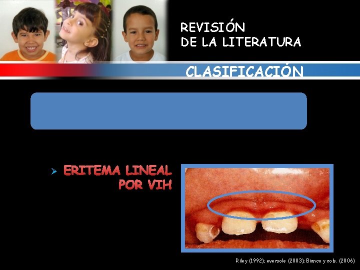 REVISIÓN DE LA LITERATURA CLASIFICACIÓN 7. ALTERACIONES GINGIVALES RELACIONADAS CON INFECCIONES VIRALES. VIRUS VIH