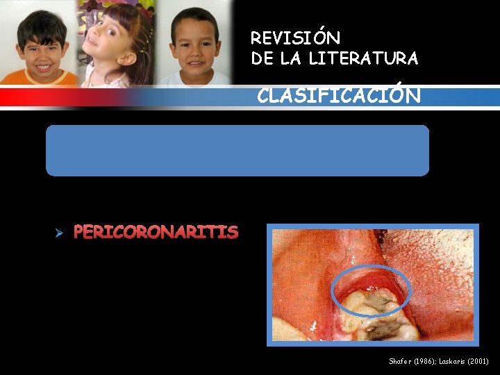 REVISIÓN DE LA LITERATURA CLASIFICACIÓN 8. ALTERACIONES GINGIVALES RELACIONADAS CON INFECCIONES BACTERIANAS Ø PERICORONARITIS