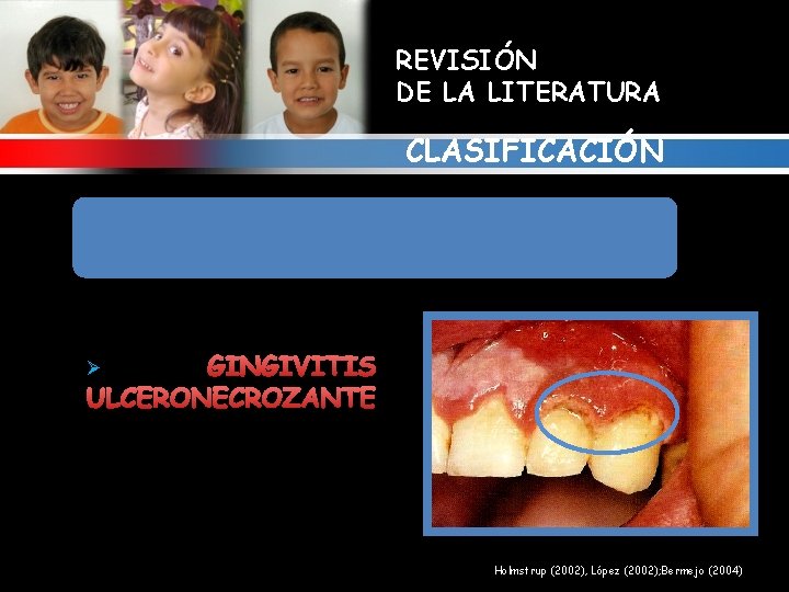 REVISIÓN DE LA LITERATURA CLASIFICACIÓN 8. ALTERACIONES GINGIVALES RELACIONADAS CON INFECCIONES BACTERIANAS GINGIVITIS ULCERONECROZANTE