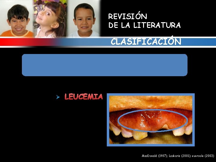 REVISIÓN DE LA LITERATURA CLASIFICACIÓN 10. ALTERACIONES GINGIVALES RELACIONADAS CON DISCRASIAS SANGUÍNEAS Ø LEUCEMIA