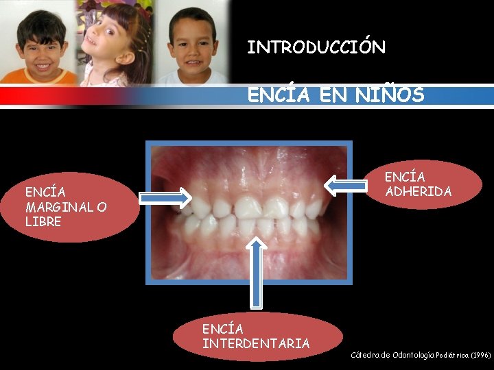 INTRODUCCIÓN ENCÍA EN NIÑOS ENCÍA ADHERIDA ENCÍA MARGINAL O LIBRE ENCÍA INTERDENTARIA Cátedra de