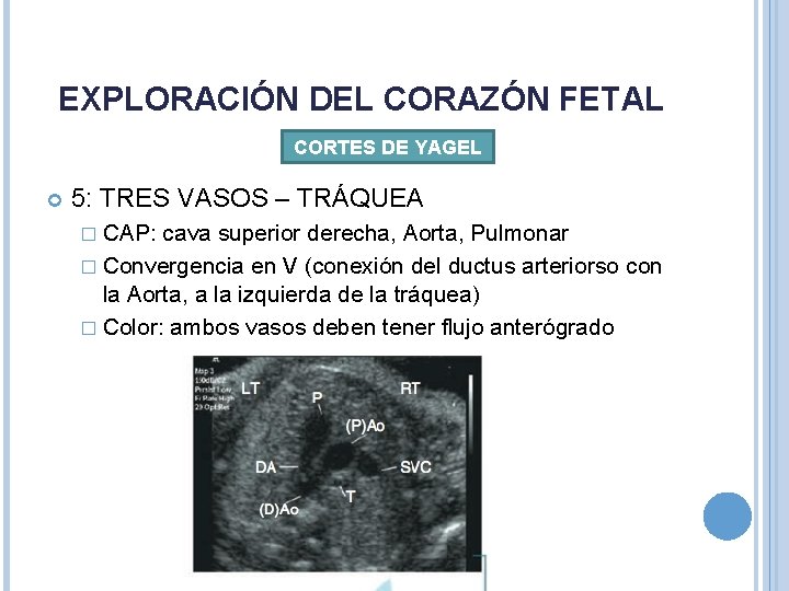 EXPLORACIÓN DEL CORAZÓN FETAL CORTES DE YAGEL 5: TRES VASOS – TRÁQUEA � CAP: EXPLORACIÓN DEL CORAZÓN FETAL CORTES DE YAGEL 5: TRES VASOS – TRÁQUEA � CAP: