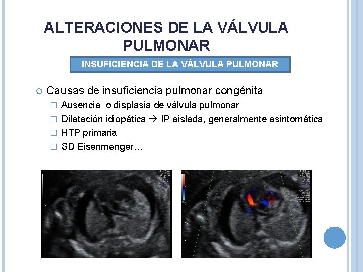 ALTERACIONES DE LA VÁLVULA PULMONAR INSUFICIENCIA DE LA VÁLVULA PULMONAR Causas de insuficiencia pulmonar ALTERACIONES DE LA VÁLVULA PULMONAR INSUFICIENCIA DE LA VÁLVULA PULMONAR Causas de insuficiencia pulmonar