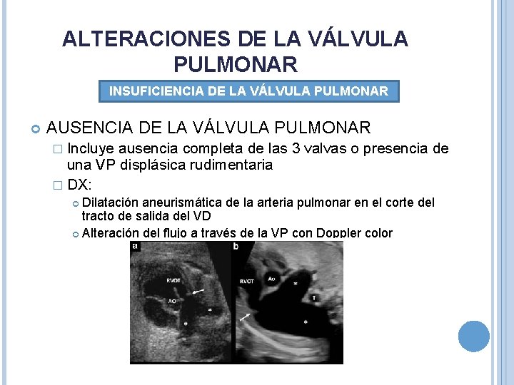 ALTERACIONES DE LA VÁLVULA PULMONAR INSUFICIENCIA DE LA VÁLVULA PULMONAR AUSENCIA DE LA VÁLVULA ALTERACIONES DE LA VÁLVULA PULMONAR INSUFICIENCIA DE LA VÁLVULA PULMONAR AUSENCIA DE LA VÁLVULA