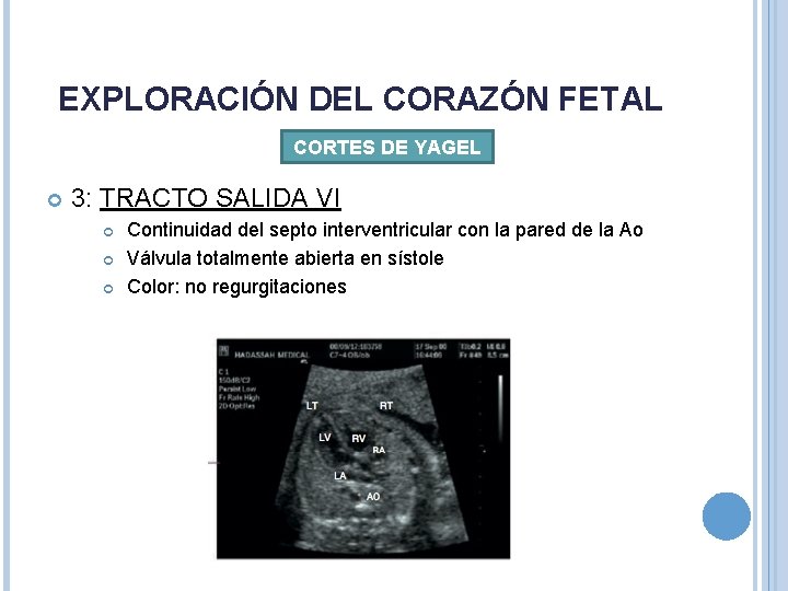 EXPLORACIÓN DEL CORAZÓN FETAL CORTES DE YAGEL 3: TRACTO SALIDA VI Continuidad del septo EXPLORACIÓN DEL CORAZÓN FETAL CORTES DE YAGEL 3: TRACTO SALIDA VI Continuidad del septo