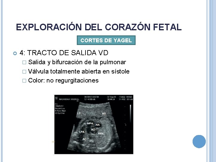 EXPLORACIÓN DEL CORAZÓN FETAL CORTES DE YAGEL 4: TRACTO DE SALIDA VD � Salida EXPLORACIÓN DEL CORAZÓN FETAL CORTES DE YAGEL 4: TRACTO DE SALIDA VD � Salida