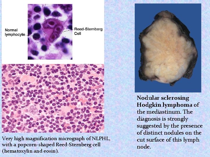 Very high magnification micrograph of NLPHL, with a popcorn-shaped Reed-Sternberg cell (hematoxylin and eosin). Very high magnification micrograph of NLPHL, with a popcorn-shaped Reed-Sternberg cell (hematoxylin and eosin).