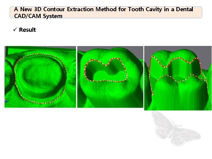 A New 3 D Contour Extraction Method for Tooth Cavity in a Dental CAD/CAM