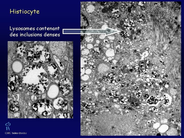 Histiocyte Lysosomes contenant des inclusions denses 