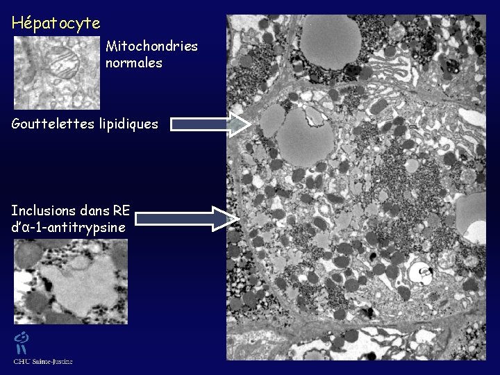 Hépatocyte Mitochondries normales Gouttelettes lipidiques Inclusions dans RE d’α-1 -antitrypsine 