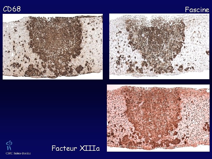 CD 68 Fascine Facteur XIIIa 