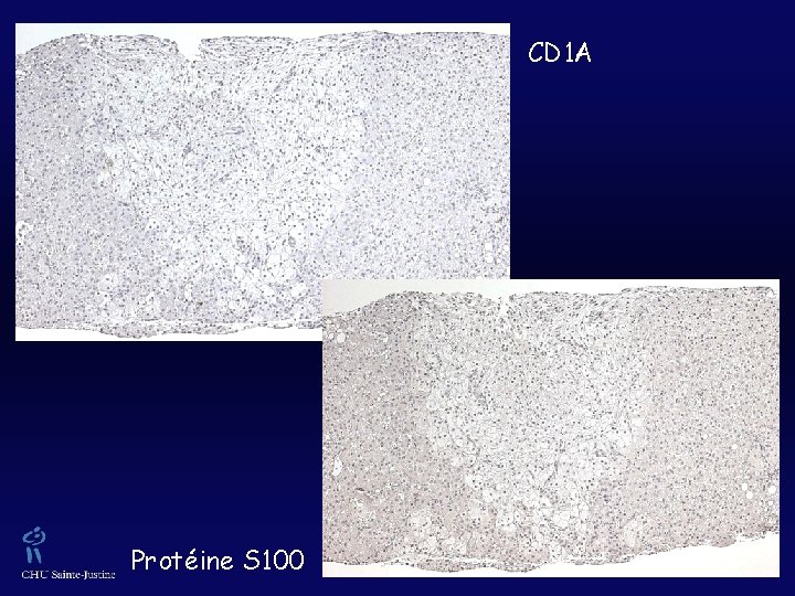 CD 1 A Protéine S 100 