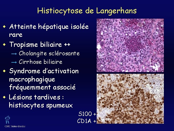Histiocytose de Langerhans w Atteinte hépatique isolée rare w Tropisme biliaire ++ → Cholangite