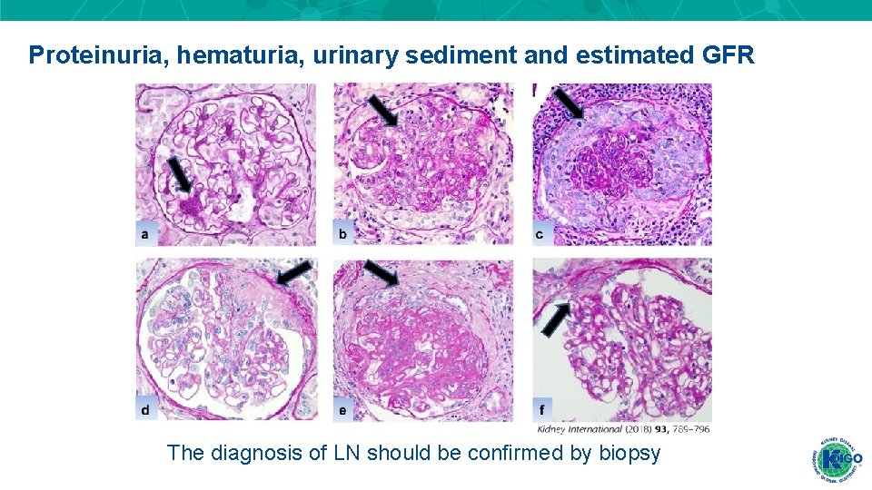 Proteinuria, hematuria, urinary sediment and estimated GFR The diagnosis of LN should be confirmed Proteinuria, hematuria, urinary sediment and estimated GFR The diagnosis of LN should be confirmed