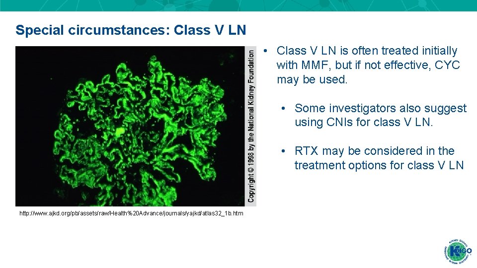 Special circumstances: Class V LN • Class V LN is often treated initially with Special circumstances: Class V LN • Class V LN is often treated initially with