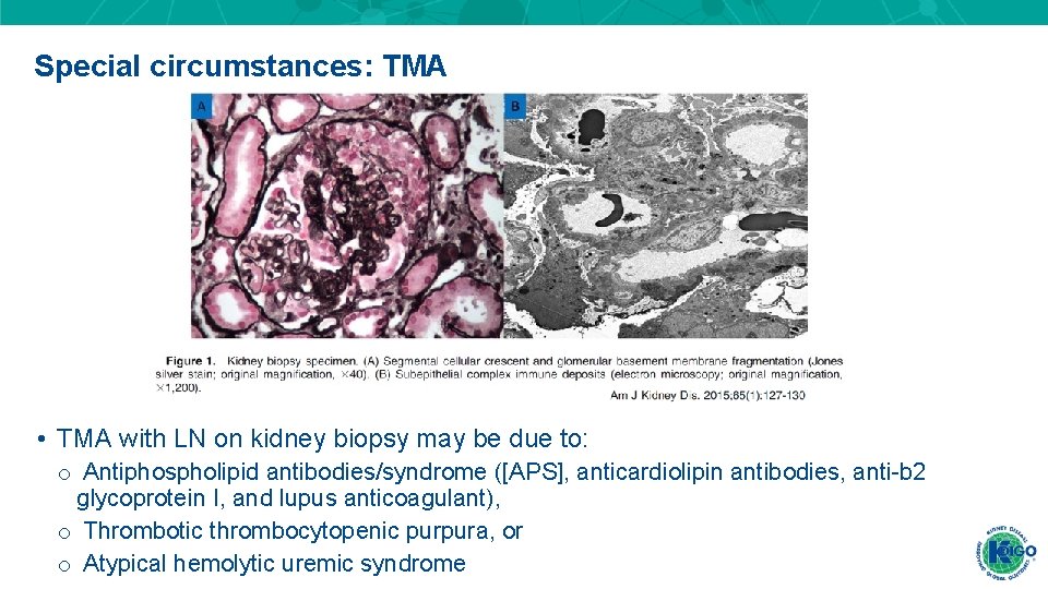 Special circumstances: TMA • TMA with LN on kidney biopsy may be due to: Special circumstances: TMA • TMA with LN on kidney biopsy may be due to: