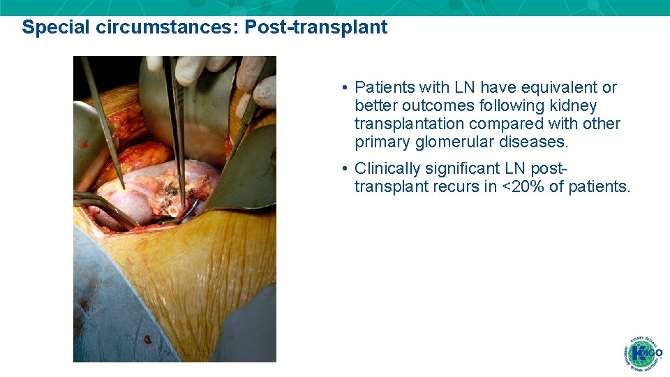 Special circumstances: Post-transplant • Patients with LN have equivalent or better outcomes following kidney Special circumstances: Post-transplant • Patients with LN have equivalent or better outcomes following kidney