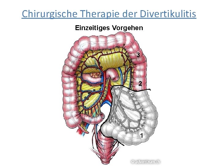 Chirurgische Therapie der Divertikulitis Einzeitiges Vorgehen 