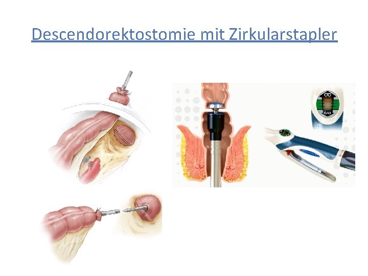 Descendorektostomie mit Zirkularstapler 