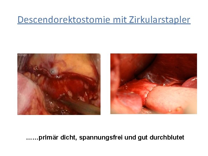 Descendorektostomie mit Zirkularstapler ……primär dicht, spannungsfrei und gut durchblutet 