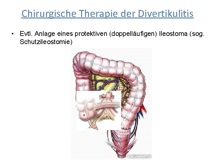 Chirurgische Therapie der Divertikulitis • Evtl. Anlage eines protektiven (doppelläufigen) Ileostoma (sog. Schutzileostomie) 