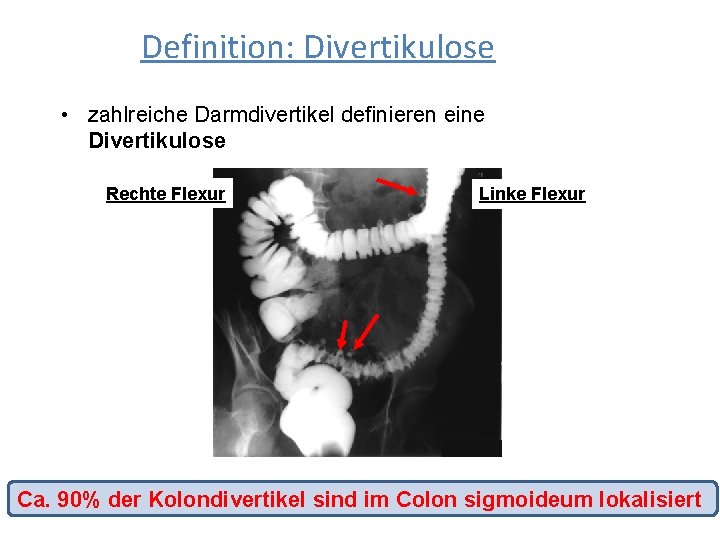 Definition: Divertikulose • zahlreiche Darmdivertikel definieren eine Divertikulose Rechte Flexur Linke Flexur Ca. 90%