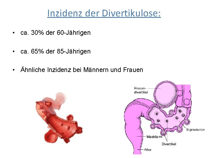 Inzidenz der Divertikulose: • ca. 30% der 60 -Jährigen • ca. 65% der 85