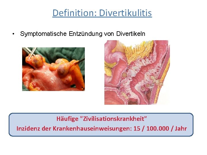 Definition: Divertikulitis • Symptomatische Entzündung von Divertikeln Häufige "Zivilisationskrankheit" Inzidenz der Krankenhauseinweisungen: 15 /