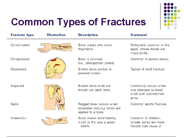 Common Types of Fractures 