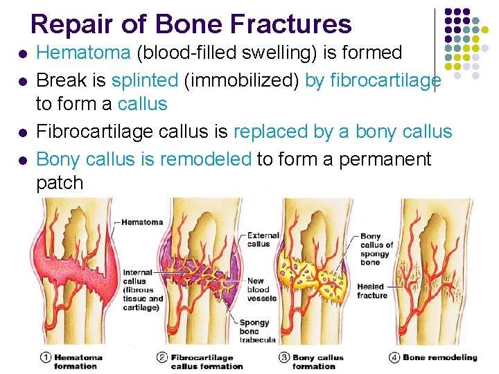 Repair of Bone Fractures l l Hematoma (blood-filled swelling) is formed Break is splinted