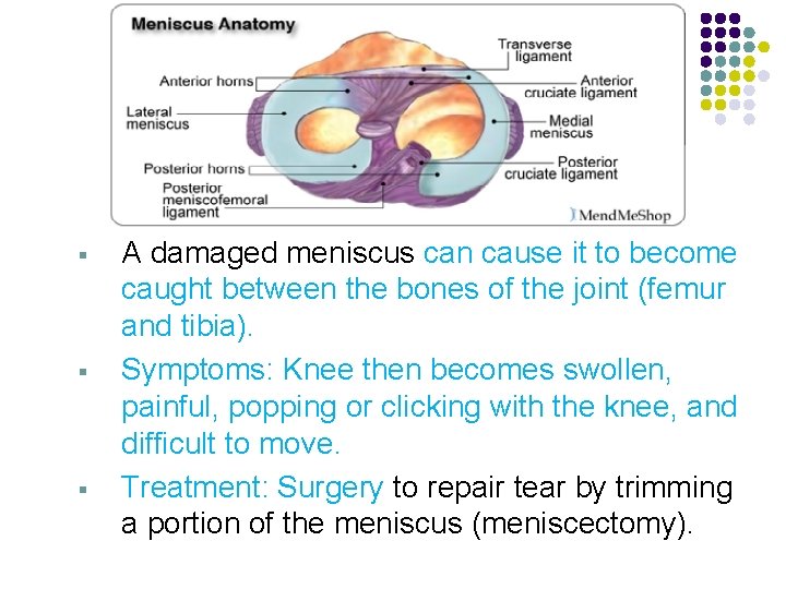 § § § A damaged meniscus can cause it to become caught between the