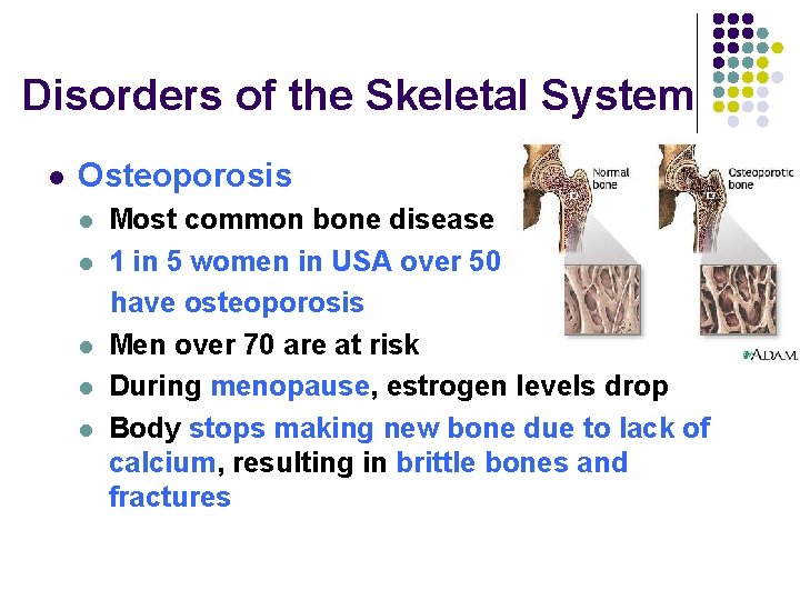 Disorders of the Skeletal System l Osteoporosis l l l Most common bone disease