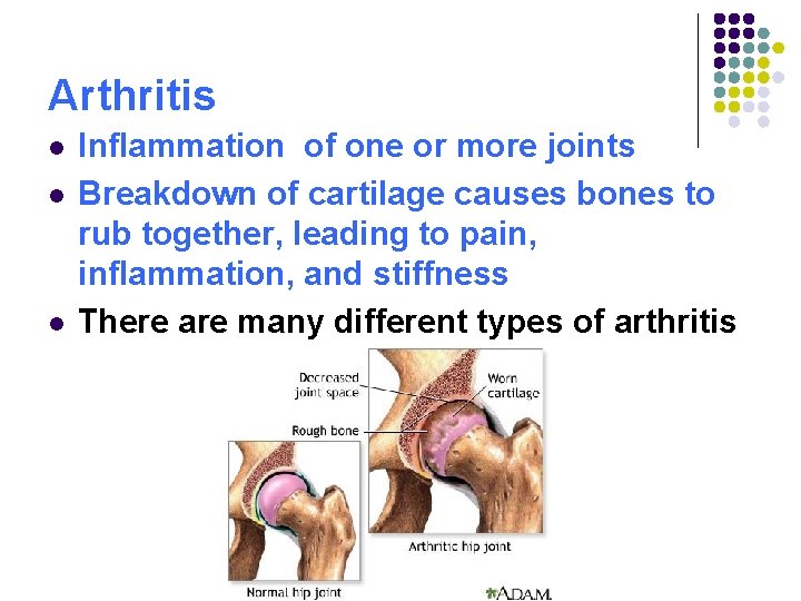 Arthritis l l l Inflammation of one or more joints Breakdown of cartilage causes