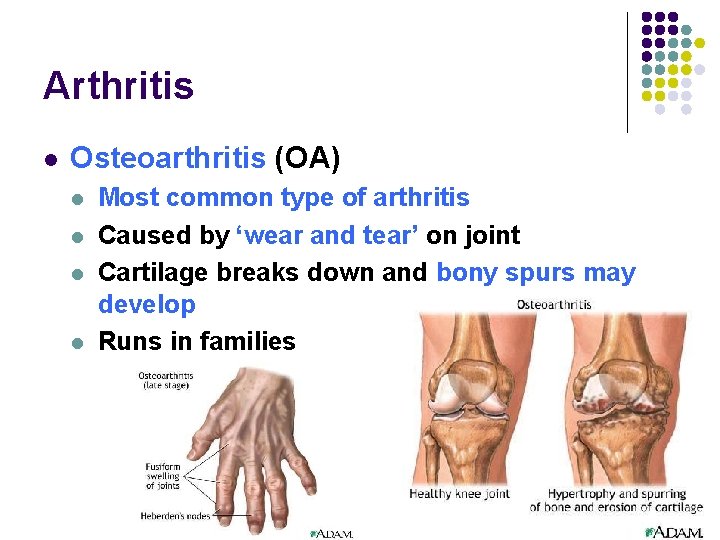 Arthritis l Osteoarthritis (OA) l l Most common type of arthritis Caused by ‘wear