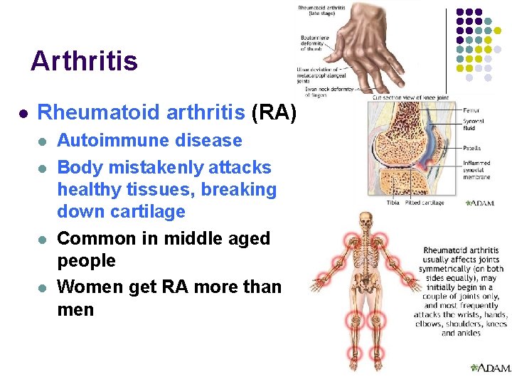 Arthritis l Rheumatoid arthritis (RA) l l Autoimmune disease Body mistakenly attacks healthy tissues,