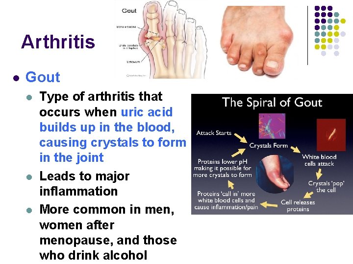 Arthritis l Gout l l l Type of arthritis that occurs when uric acid