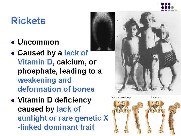 Rickets l l l Uncommon Caused by a lack of Vitamin D, calcium, or