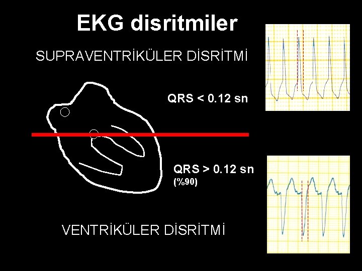 EKG disritmiler SUPRAVENTRİKÜLER DİSRİTMİ QRS < 0. 12 sn QRS > 0. 12 sn