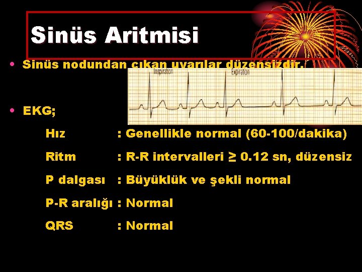 Sinüs Aritmisi • Sinüs nodundan çıkan uyarılar düzensizdir. • EKG; Hız : Genellikle normal