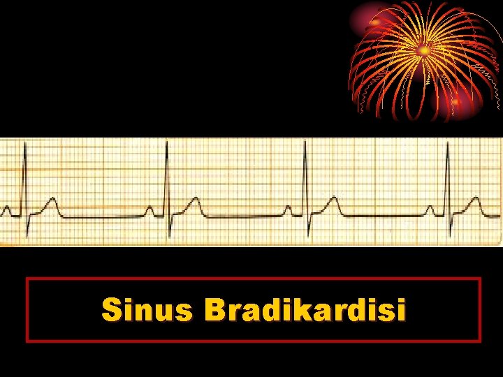 Sinus Bradikardisi 