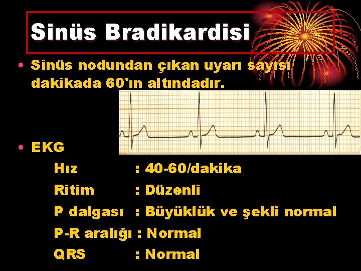 Sinüs Bradikardisi • Sinüs nodundan çıkan uyarı sayısı dakikada 60'ın altındadır. • EKG Hız