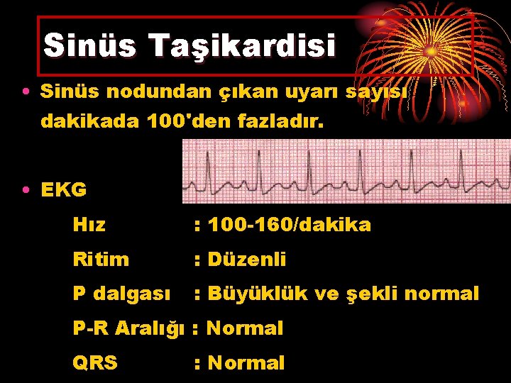 Sinüs Taşikardisi • Sinüs nodundan çıkan uyarı sayısı dakikada 100'den fazladır. • EKG Hız