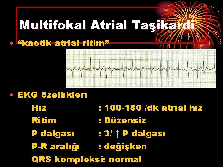 Multifokal Atrial Taşikardi • “kaotik atrial ritim” • EKG özellikleri Hız : 100 -180