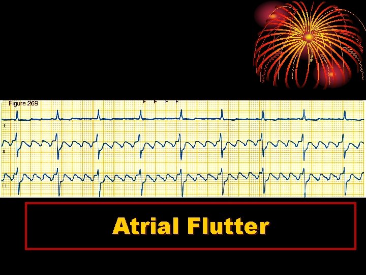 Atrial Flutter 